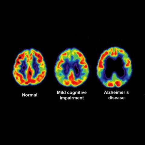 Alzheimer's, Dementia, Cause By Carbs?
