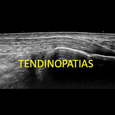 TENDINOPATIAS PARTE III - TEORIA DO ICEBERG E EXAMES DE IMAGEM