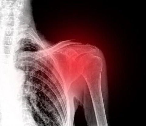 Terapia dell'artrite alla spalla con la tecnologia CEMP