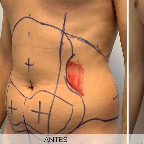 La liposucción ¿Es común en los hombres? Conversamos con el dr. Miguel Mota Cabral