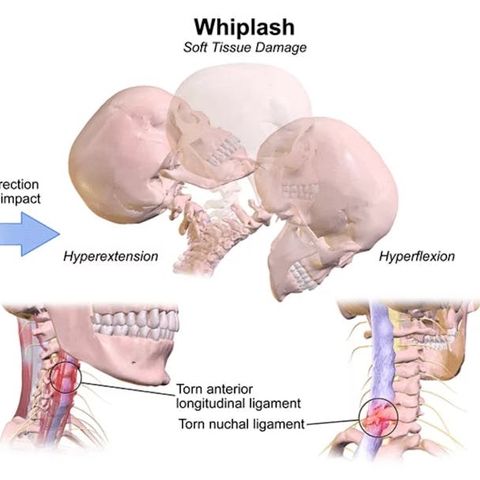 Whiplash Treatment