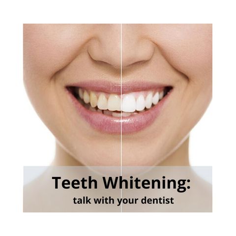 Teeth Whitening: Why should you choose professional teeth whitening?