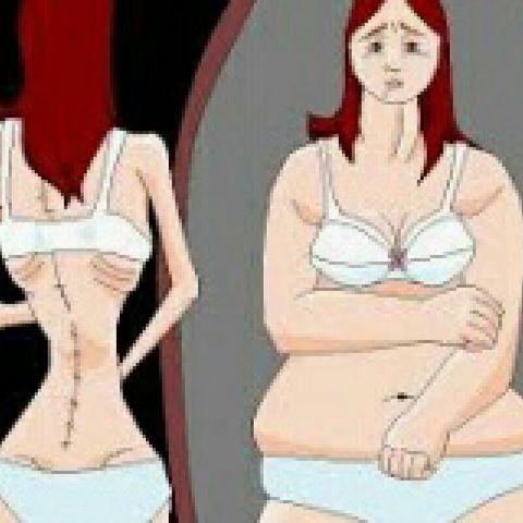 Capitulo II: Bulimia Y Anorexia