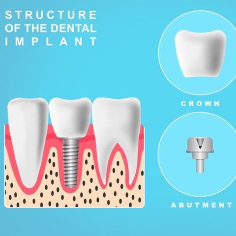 Dental Implants Prosper