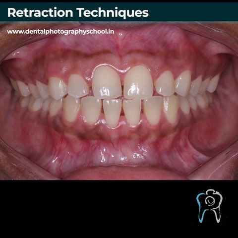 Retraction in dental photography