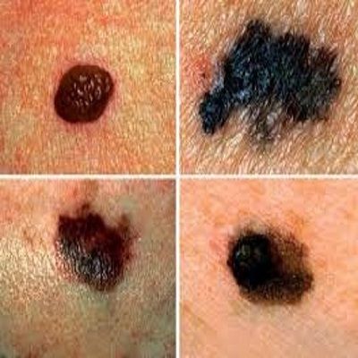 Cancer de piel melanoma y no melanoma