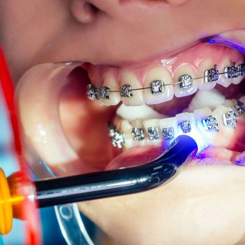 What improvements have been made to braces