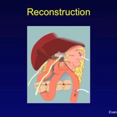 Managing Pancreatic Cancer: Surgery for Pancreatic Cancer, Its Complications, and the Importance of Surgical Volume (video)