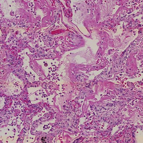 Cellular changes as lung damage worsens in COVID-19 revealed