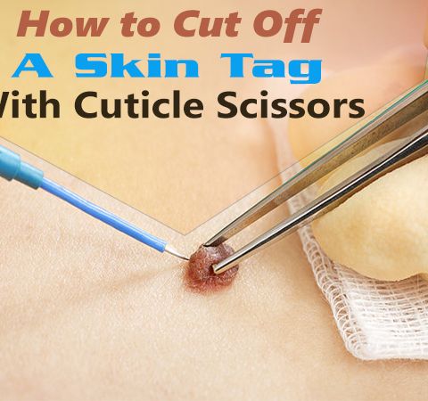 Removing Skin Tags-How to Cut Off a Skin Tag with Cuticle Scissors and More