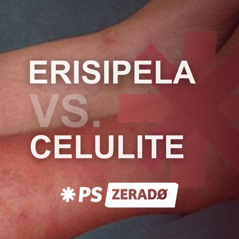 Erisipela ou Celulite? Como Não Errar no Diagnóstico