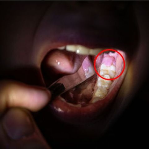 Pediatric Infant & Child Abscess on Gum Near Tooth | Pictures ...