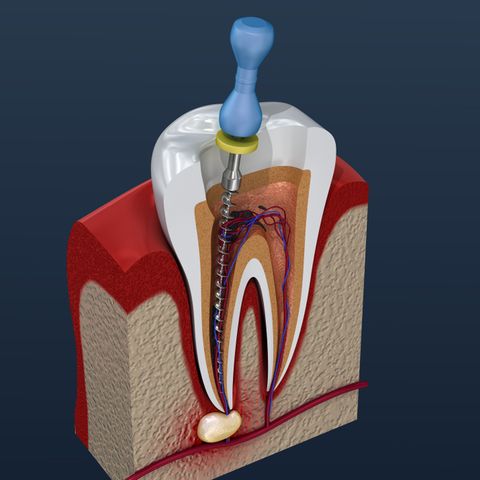 5 Root Canal Treatment alternatives