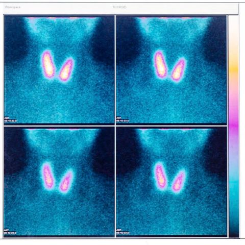 194: Thyroid help