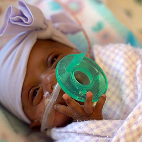 Size of an apple Girl becomes tiniest newborn to survive