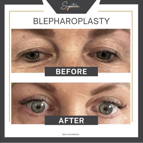 Signature - Eyelid Reduction (Blepharoplasty)