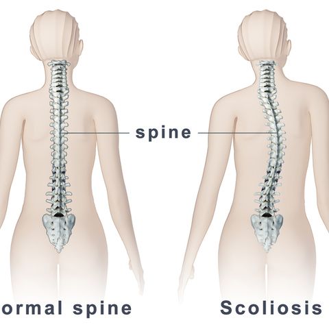 Scoliose sans douleur