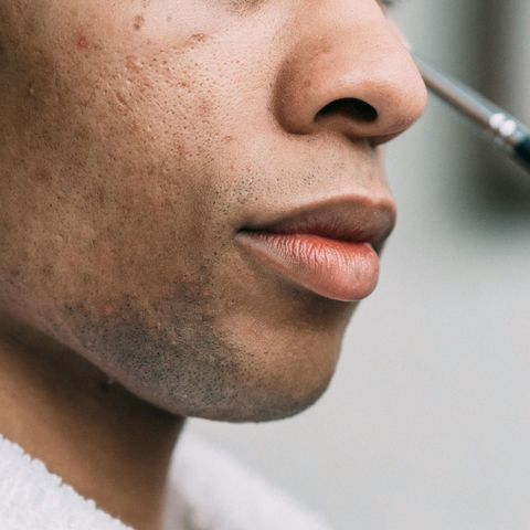 Es Salud: Acné