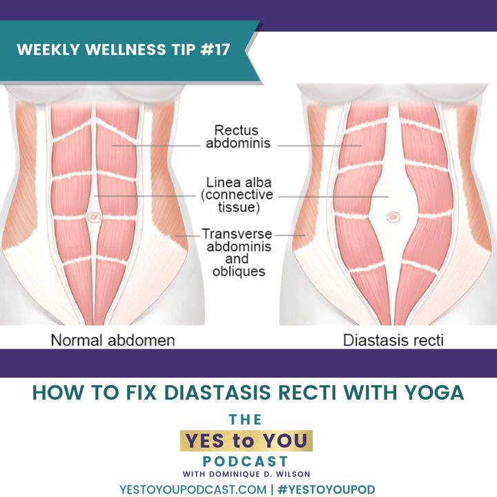 How To Fix Diastasis Recti with Yoga | Weekly Wellness Tip 17
