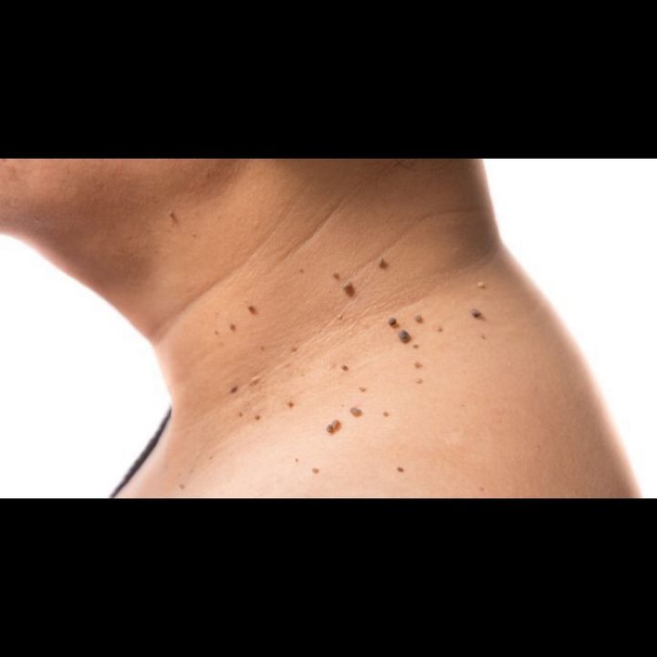 153 - Skin Tags? Do This!