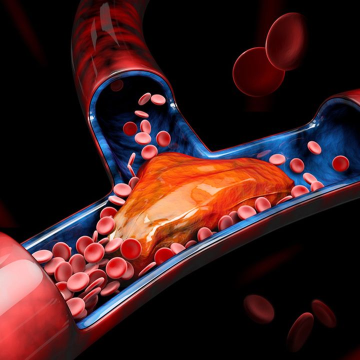 Blacks & Blood Clots: One of the reasons why heart attacks and strokes are killing us.