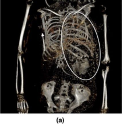 Uno studio sulle mummie dell'antico Egitto identifica la morte per parto
