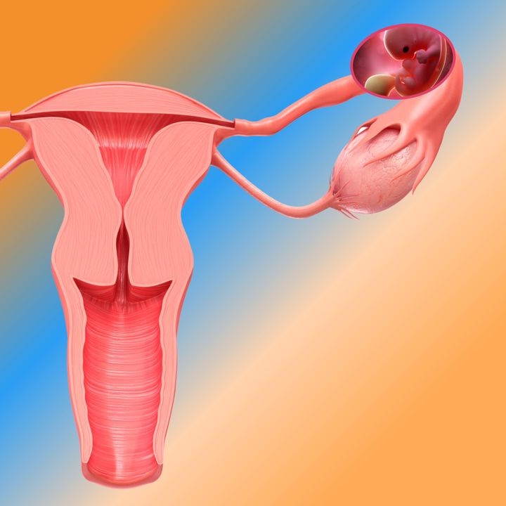 🤰🏻Gravidanza Ectopica Extrauterina e Intrauterina