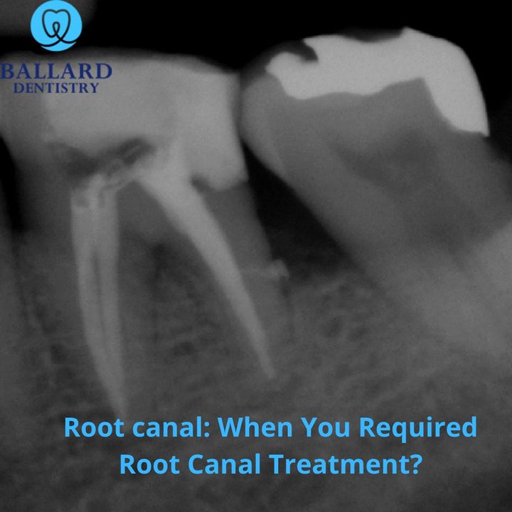 Root Canal: Latest Technologies To Performed Advance Treatment