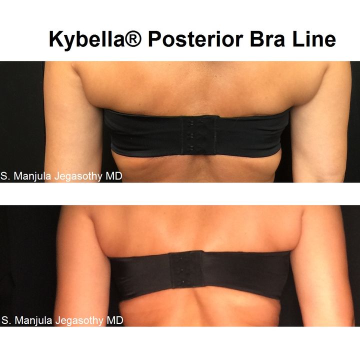 Health Check: How To Nonsurgically Get Rid of Bra Line Fat with Kybella® Fat  Melting