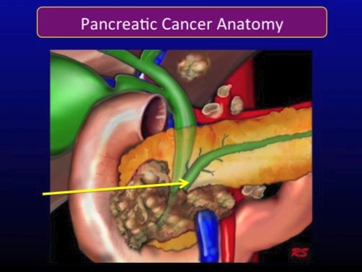 Chemotherapy for Pancreatic Cancer, Part 2: Resectable vs. Unresectable Pancreatic Cancer (video)