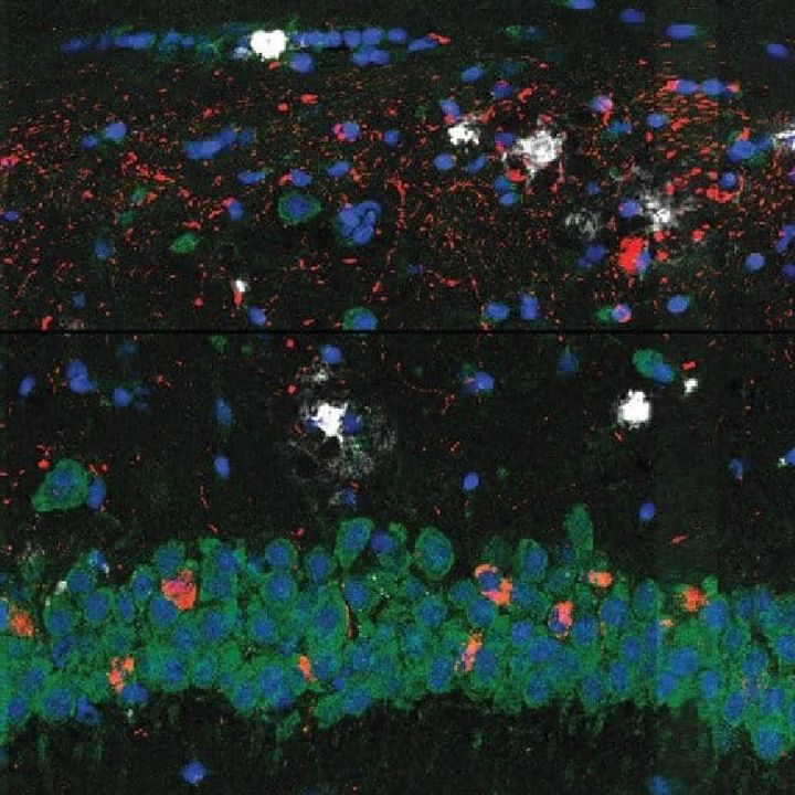 Brain Cell Changes in Alzheimer’s Disease Mapped [W[R]C]